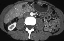 Clot in Gonadal Vein - CTisus CT Scan