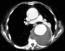 Aneurysm Erodes the Spine - CTisus CT Scan