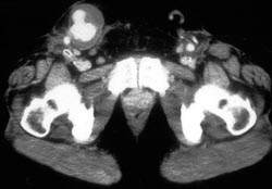 Arteriovenous Malformation (AVM) - CTisus CT Scan