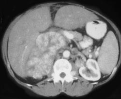 Inferior Vena Cava (IVC) Sarcoma - CTisus CT Scan