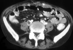 Right Iliac Vein Thrombosis - CTisus CT Scan