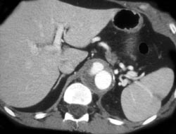 Dissection - CTisus CT Scan