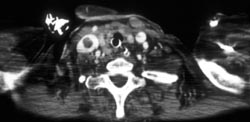 Jugular Vein Clot - CTisus CT Scan