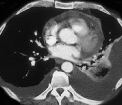 Pulmonary Embolism - CTisus CT Scan