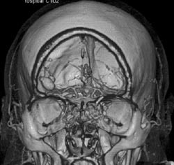 Middle Cerebral Artery Aneurysm - CTisus CT Scan