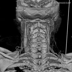 Occluded Carotid Artery - CTisus CT Scan