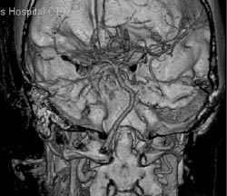 Basilar Artery - CTisus CT Scan