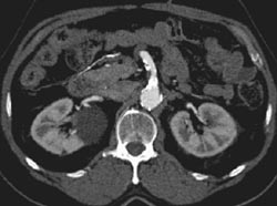 Plaque in SMA - CTisus CT Scan