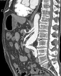 Kink in Graft - CTisus CT Scan