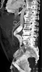 Failed Stent With Kinking - CTisus CT Scan