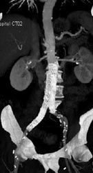 Endovascular Stent - CTisus CT Scan