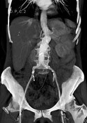 Aortic Aneurysm - CTisus CT Scan