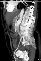 Aortic Aneurysm - CTisus CT Scan