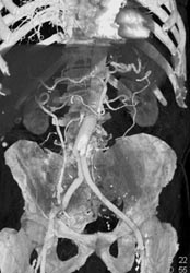 Aneurysm Repair - CTisus CT Scan