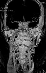 Carotid Circulation - CTisus CT Scan