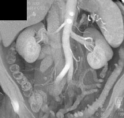 Normal IMA - CTisus CT Scan