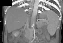 Hepatic Artery Directly Off Aorta - CTisus CT Scan