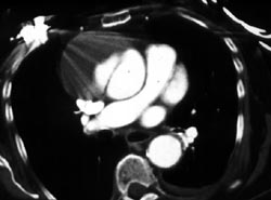 Type A Dissection - CTisus CT Scan