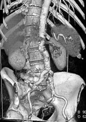 Aneurysm Post Repair - CTisus CT Scan