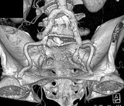 Iliac Vessels - CTisus CT Scan