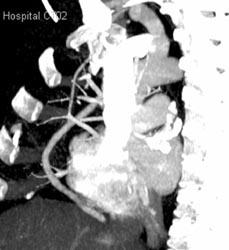 Patent Coronary Artery Graft - CTisus CT Scan