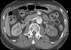 Renal Infarct and Aortic Dissection - CTisus CT Scan