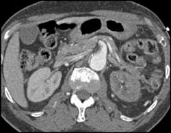 Aortic Dissection and Left Renal Infarction - CTisus CT Scan