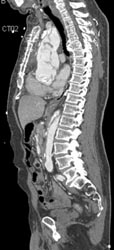 Type A Dissection - CTisus CT Scan