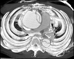 Type A Dissection - CTisus CT Scan