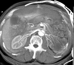 Aortic Dissection - CTisus CT Scan