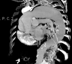 Dilated Arch With Type A Dissection - CTisus CT Scan