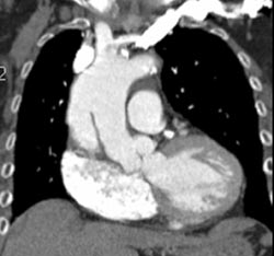 Type A Dissection - CTisus CT Scan