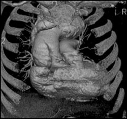 Type A Dissection in 2 Rendering Modes - CTisus CT Scan