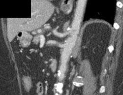 Clot in SMA With Focal Dissection - CTisus CT Scan