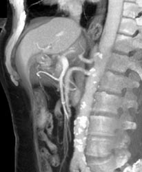 Focal Dissection in SMA With Clot - CTisus CT Scan