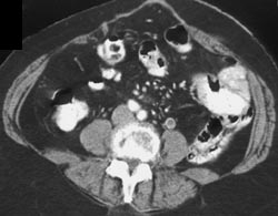 Left Gonadal Vein Thrombosis - CTisus CT Scan