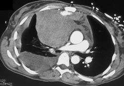 Leak From Internal Mammary Artery Injury - CTisus CT Scan