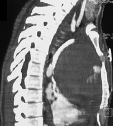 Anterior Mediastinal Hematoma - CTisus CT Scan