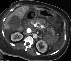 Portal Vein- Hepatic Artery Fistulae - CTisus CT Scan