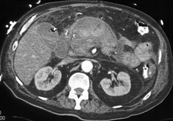 Hemorrhagic Pancreatitis - CTisus CT Scan