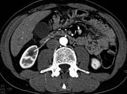 Accessory Right Renal Artery Led to A Ureteropelvic Junction (UPJ) - CTisus CT Scan