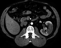 Renal Infarction - CTisus CT Scan