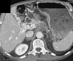 Cavernous Transformation of the Portal Vein Due to Pancreatic Cancer - CTisus CT Scan