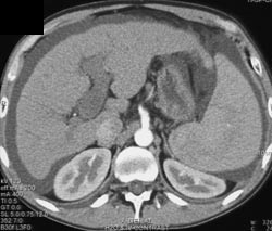 Portal Vein Thrombosis - CTisus CT Scan