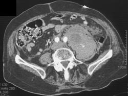 Active Bleed Into Left Psoas Muscle - CTisus CT Scan