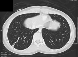 Pulmonary Arteriovenous Malformations (AVMs) - CTisus CT Scan