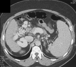 Extensive Perihepatic Varices - CTisus CT Scan