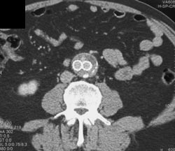 Leak From Stent - CTisus CT Scan