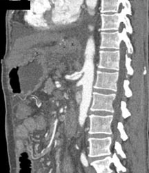 Dissection Into Celiac Artery - CTisus CT Scan