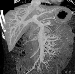 Normal Hepatic Venous Anatomy - CTisus CT Scan